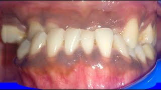 Virtual Orthodontics during Clear Aligner Treatments Case by Dr Vandana Katyal Orthodontist [upl. by Nagad757]