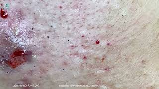 Big Cystic Acne Blackheads Extraction Blackheads amp Milia Whiteheads Removal Pimple Popping [upl. by Aramit712]