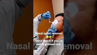 Nasal splint removal septoplasty [upl. by Wyler]