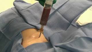 Bone Marrow Aspiration Cannula Ant Iliac Crest Instructions [upl. by Aihsoj]