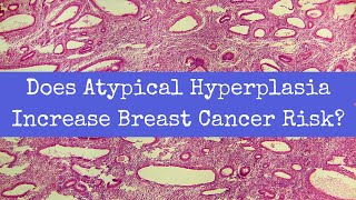 Does Atypical Hyperplasia Increase Breast Cancer Risk [upl. by Haidebez]