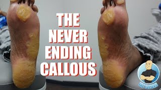 EXTREME UNBELIEVABLE NEVER ENDING THICKEST FOOT CALLUSCALLOUS REMOVAL [upl. by Sabas]