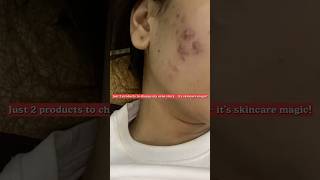 Cleared my skin with just 2 miracle products acne skincareroutine acnejourney ytshorts [upl. by Otilopih]