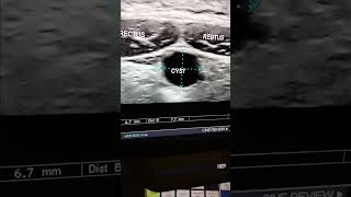 Rectus sheath cystultrasound abdominal [upl. by Colvert]