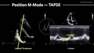 〖Echocardiography〗 TAPSE  right ventricular function with MMode [upl. by Derry558]