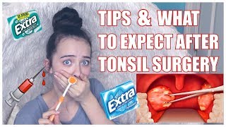 TIPS AND WHAT TO EXPECT AFTER TONSIL SURGERY [upl. by Assennav]