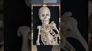 Fibrodysplasia ossificans progressiva FOP [upl. by Idahs768]