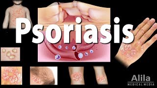 Psoriasis Types Symptoms Causes Pathology and Treatment Animation [upl. by Keifer]