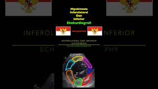 Ekokardiografi  Hipokinesia Inferolateral Dan Inferior [upl. by Emanuele]