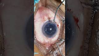 Phaco Direct Chop Phacoemulsification Cataract Surgery [upl. by Aihpos]