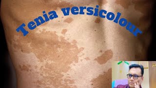 Tinea versicolour treatment Tinea versicolour causes fungal [upl. by Doreen]