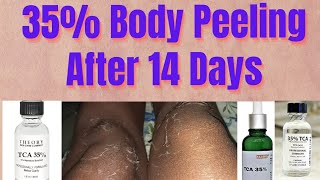 35 TCA Chemical Peel Before After Body Peeling After 14 Day पीलिंग देर से हुई [upl. by Burgwell]