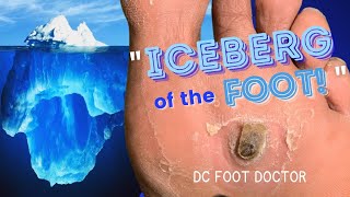 Iceberg of the Foot Removing Painful Pororkeratosis [upl. by Woodrow722]