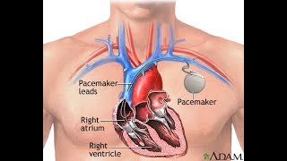 Now powered by Pacemaker  A health update [upl. by Elleret969]