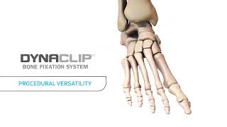 DynaClip® Bone Fixation System Animation [upl. by Adelice369]