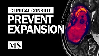 Clinical Consult Prevent Expansion [upl. by Ahsed]