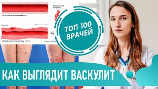 Что такое Васкулит фото 18 Геморрагический васкулит кожи Симптомы васкулита на ногах [upl. by Adirem94]