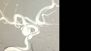 Endovascular coil embolization of unruptured posterior communicating artery aneurysm [upl. by Diannne]