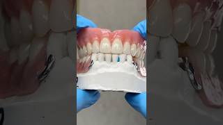 Upper Denture and Lower Partial lsk121shorts dentistteeth dentistry [upl. by Nyleahs746]