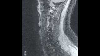 Cspine MRI withwithout contrast [upl. by Danete]