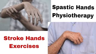 Spastic Hands Exercises  Stroke hands physiotherapy treatment  Hands physiotherapy physiotherapy [upl. by Eisset]