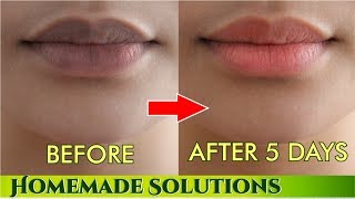 काले होंठो प्राक्रतिक गुलाबी बनाने के नुस्खे  Remove darkness from lips get pink lips [upl. by Jayson528]