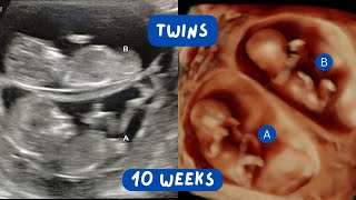 Cute Ultrasound Video of Twins at 11 Weeks Gestation  Scan of the Week [upl. by Qirat]