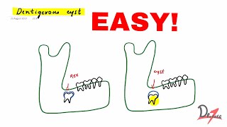 Dentigerous cyst made easy [upl. by Bal]