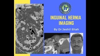 TMT Inguinal Hernia Imaging by Dr Jeshil Shah [upl. by Nedak]