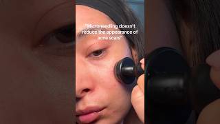 How to boost collagen elastin and improve texture and acne scars over time🙌🏽 microneedlingface [upl. by Tingey]