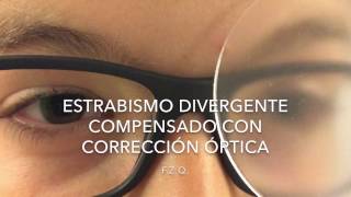 Estrabismo divergente compensado con corrección óptica [upl. by Hafler76]