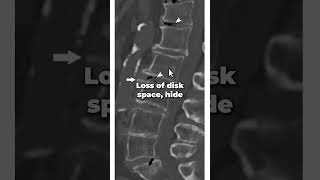 What does a degenerated spine look like on xray [upl. by Alliuqat]