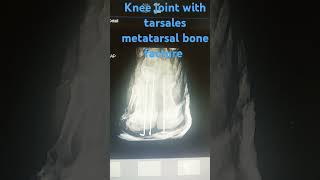 Knee joint with tarsales metatarsal bone facture [upl. by Aniweta]