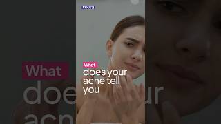 What does your acne tell you acne skincare [upl. by Korten]