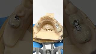 PFM Posteriors with Mesial and Distal Rests EnvisiontecMain envisiontec lsk121shorts dentist [upl. by Nereids366]