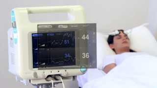 Ornim Medicals Revolutionary Cerebral Blood Flow Monitor English [upl. by Ettenirt]