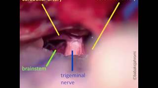 Trigeminal Neuralgia [upl. by Amrita568]