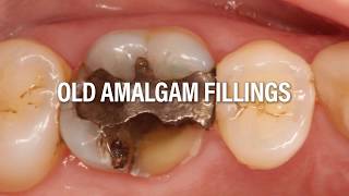 Replace your old amalgams with porcelain restorations with Dr Samadian [upl. by Adnirol]