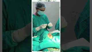 Excision of Ranula  Surgery  Ranula treatment  Dr Ranjana Butola [upl. by Onitnelav]