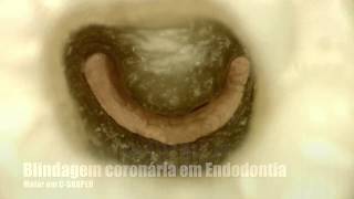 Vídeo de Parceiros Blindagem em Endodontia com Prof Edgar Valdivia [upl. by Noiroc920]