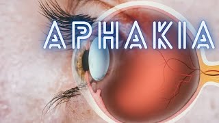 Aphakia  Ophthalmology Lecture [upl. by Edi]