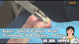 Super Thick Fungal Nails Trimming in Podiatry Office [upl. by Mauchi]