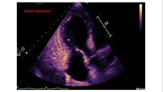 Takotsubo Cardiomyopathy broken heart syndrome [upl. by Esikram]