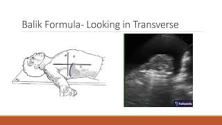 Tutorial USGuided Thoracentesis [upl. by Hannahc]