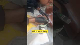 Microneedling Treatment For Face  Microneedling Healing Process  Microneedling Before And After [upl. by Leciram]