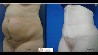 Fotos Abdominoplastia de Mujeres Antes y Después  Dr Julio Gil de Bogotá [upl. by Huberty]