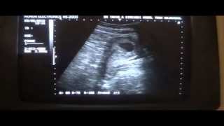 ultrasound 7 wks 5 days normal pregnancy [upl. by Akinej]