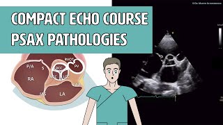 〖Echocardiography〗 Parasternal short axis  Pathologies PSAX [upl. by Emyam405]