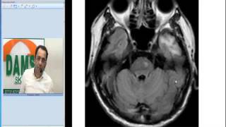 Radiology Spotters by Dr Sumer Sethi 34  Wallerian Degeneration [upl. by Swope]