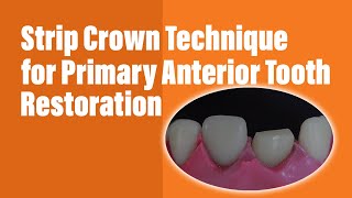 Celluloid Strip Crown for Primary Anterior Tooth Restoration ǀ Twinky Star Compomer VOCO [upl. by Janaye680]